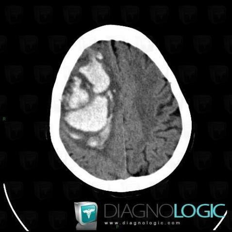 Hematoma, Cerebral hemispheres, CT