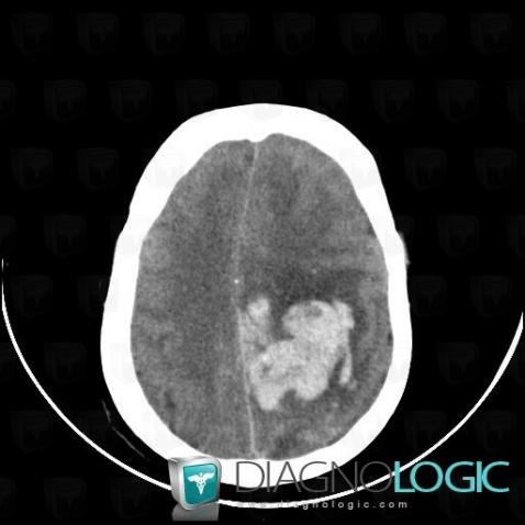 Hematoma, Cerebral hemispheres, CT