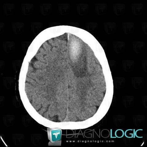 Hematoma, Cerebral hemispheres, CT