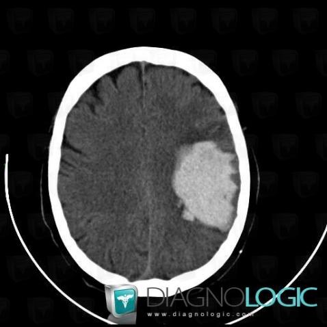 Hematoma, Cerebral hemispheres, CT