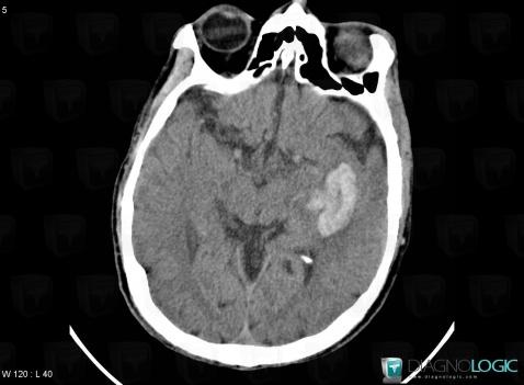 Hematoma, Cerebral hemispheres, CT