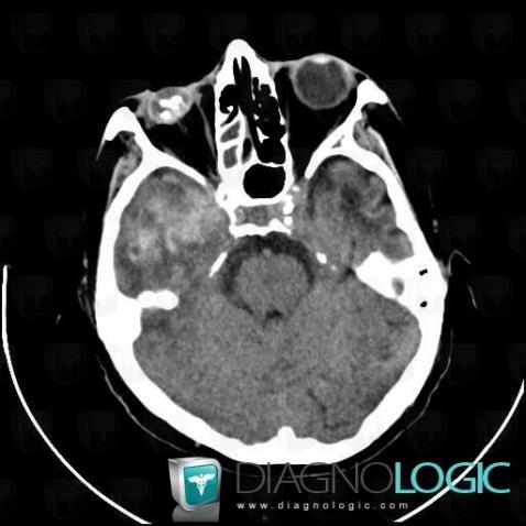 Hematoma, Cerebral hemispheres, CT