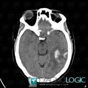 Hematoma, Cerebral hemispheres, CT