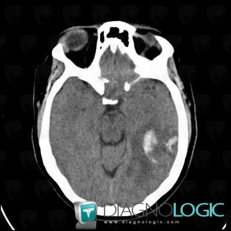Hematoma, Cerebral hemispheres, CT