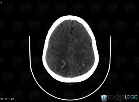 Hematoma, Cerebral hemispheres, CT