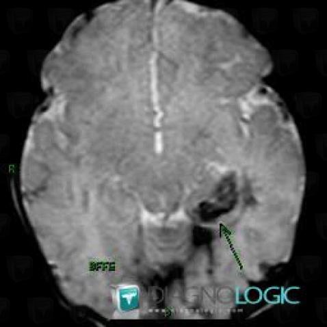 Hematoma, Cerebral hemispheres, MRI