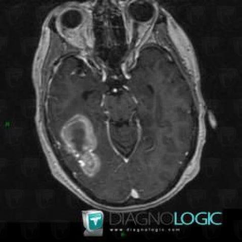 Hematoma, Cerebral hemispheres, MRI