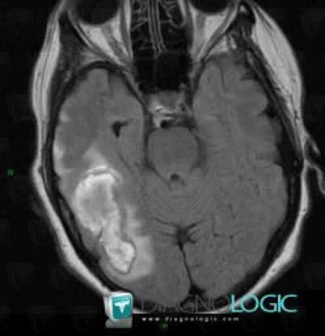 Hematoma, Cerebral hemispheres, MRI