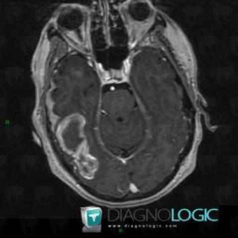 Hematoma, Cerebral hemispheres, MRI