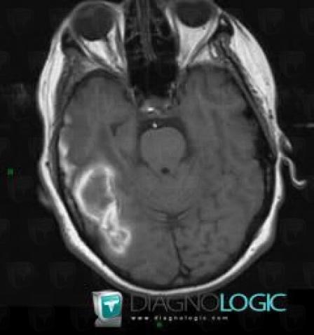 Hematoma, Cerebral hemispheres, MRI