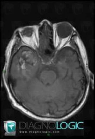 Hematoma, Cerebral hemispheres, MRI