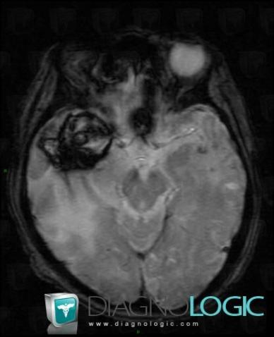 Hematoma, Cerebral hemispheres, MRI