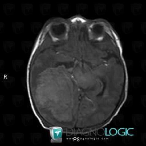 Hematoma, Cerebral hemispheres, MRI