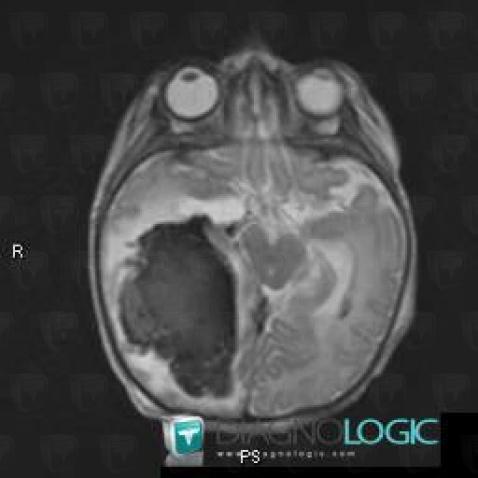 Hematoma, Cerebral hemispheres, MRI