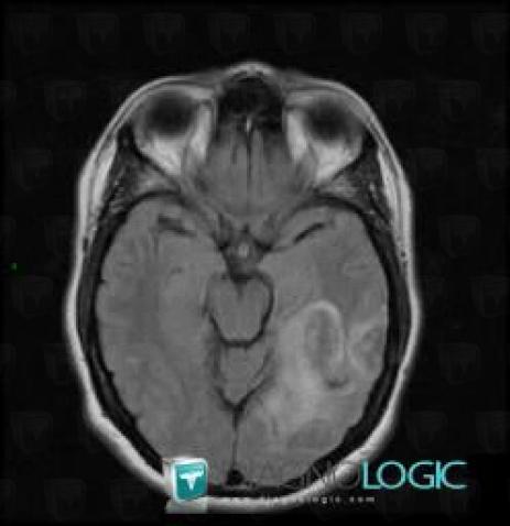 Hematoma, Cerebral hemispheres, MRI