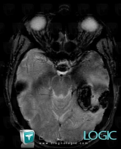 Hematoma, Cerebral hemispheres, MRI