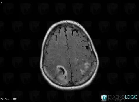 Hematoma, Cerebral hemispheres, MRI