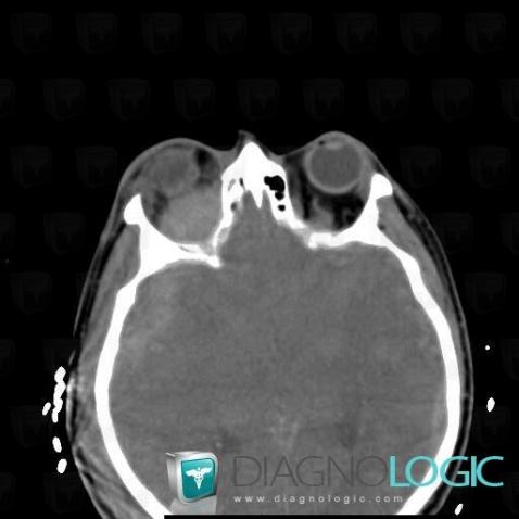 Hematoma, Eye, CT