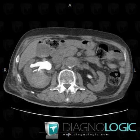 Hematoma, Kidney, CT