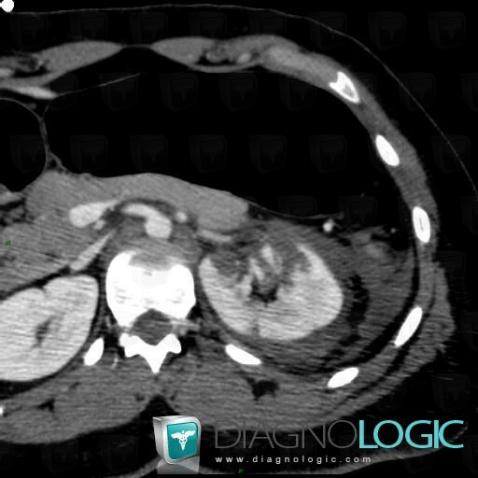 Hematoma, Kidney, Retroperitoneum, CT