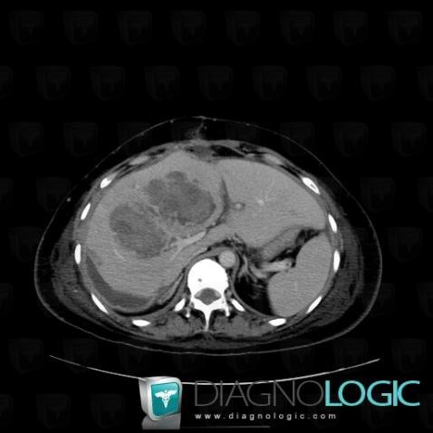 Hematoma, Liver, CT