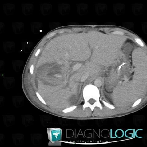 Hematoma, Liver, CT