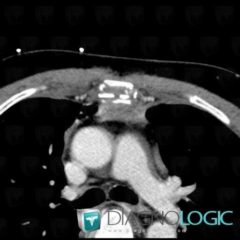 Hematoma, Mediastinum, CT