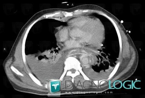 Hematoma, Mediastinum, CT