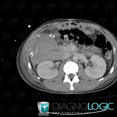 Hematoma, Mesentery / Peritoneum, CT