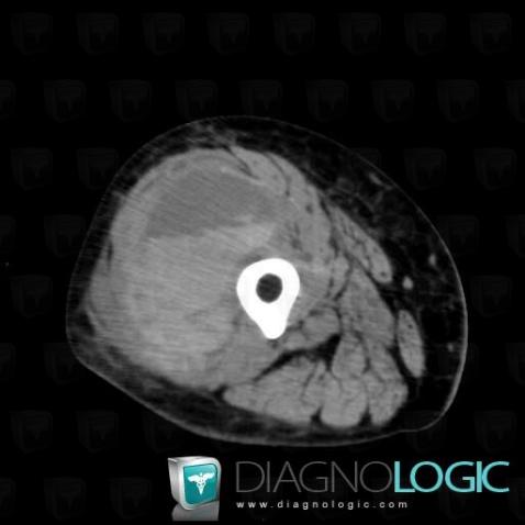 Hematoma, Muscles - Thigh, CT