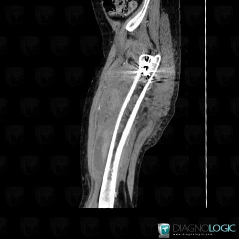 Thigh Muscle Anatomy Ct Stab Wound Thigh With Active Bleed And Muscle