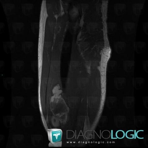 Hematoma, Muscles - Thigh, MRI