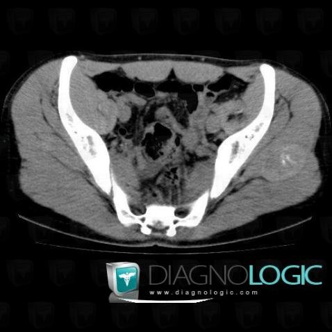 Hematoma, Other soft tissues/nerves - Pelvis, CT