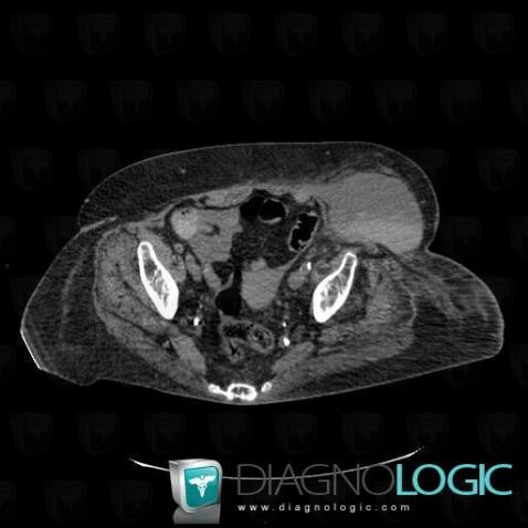 Hematoma, Other soft tissues/nerves - Pelvis, CT