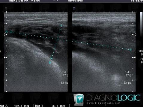 Hematoma, Other soft tissues/nerves - Pelvis, US