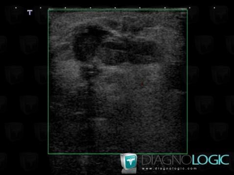 Radiology case : Hematoma (US ,CT) - Diagnologic