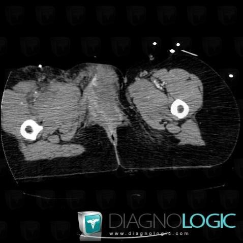 Hematoma, Pelvic Muscles, CT