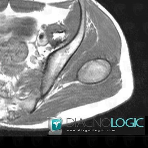 Hematoma, Pelvic Muscles, Other soft tissues/nerves - Pelvis, MRI