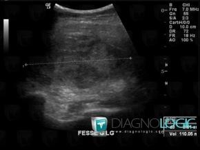 Hematoma, Pelvic Muscles, Other soft tissues/nerves - Pelvis, US