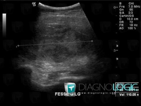 Hematoma, Pelvic Muscles, Other soft tissues/nerves - Pelvis, US