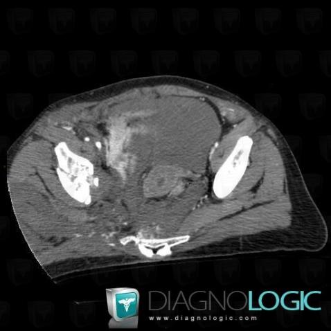 Hematoma, Pelvis / Perineum, CT