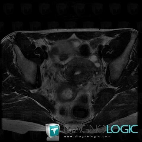 Hematoma, Pelvis / Perineum, MRI