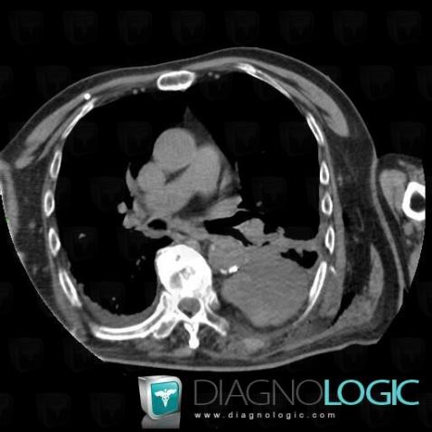 Hematoma, Pleura, CT