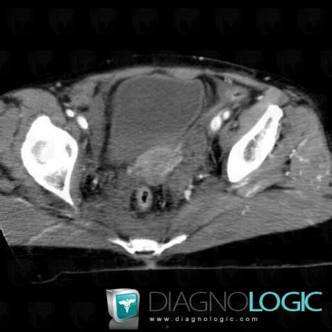Hematoma, Rectum, CT