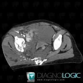 Hematoma, Rectum, Sacrum / Coccyx, CT