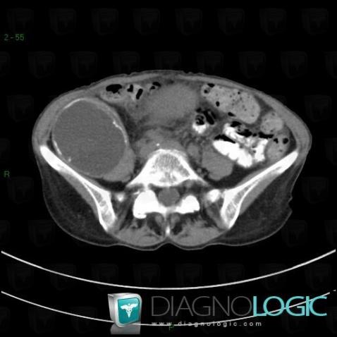 Hematoma, Retroperitoneum, CT