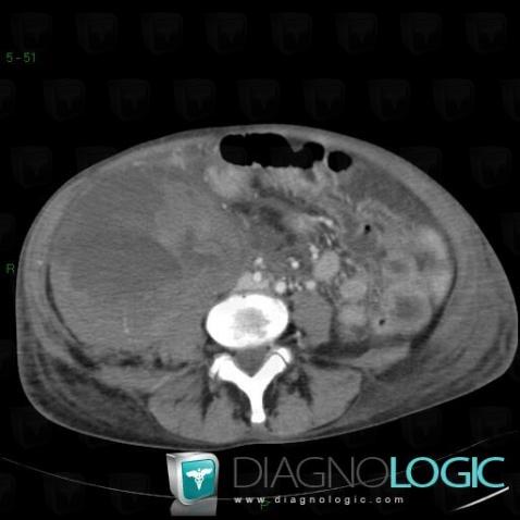 Hematoma, Retroperitoneum, CT