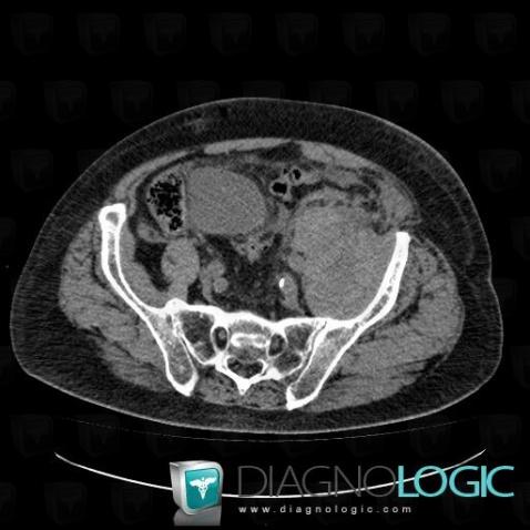 Hematoma, Retroperitoneum, CT