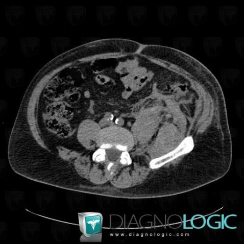 Hematoma, Retroperitoneum, CT