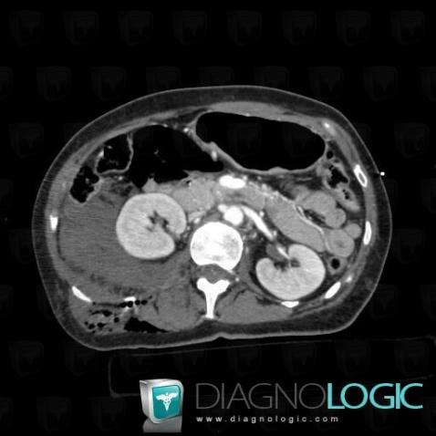 Hematoma, Retroperitoneum, CT